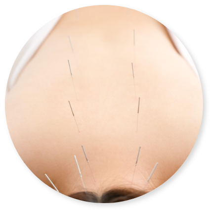 背中の鍼治療の様子