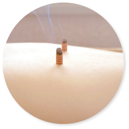 お灸治療の写真