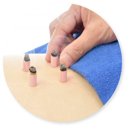 お灸治療の様子